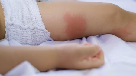 Bebe con eczema piel atopica